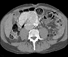 Scan of a large extra-adrenal pheochromocytoma